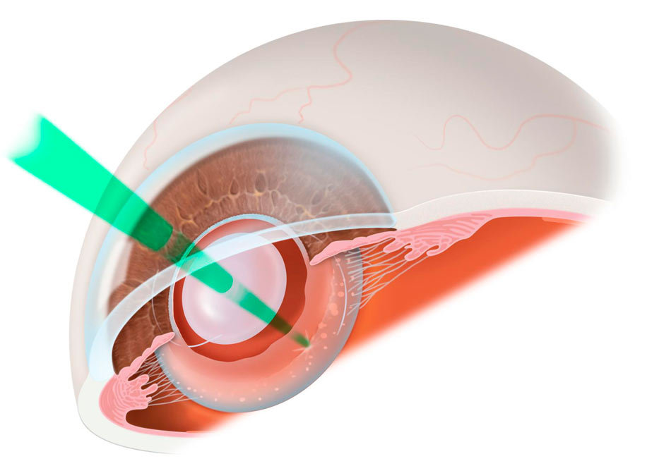 Удаление вторичной катаракты лазерным методом для восстановления зрения